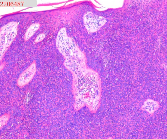 基底細(xì)胞癌