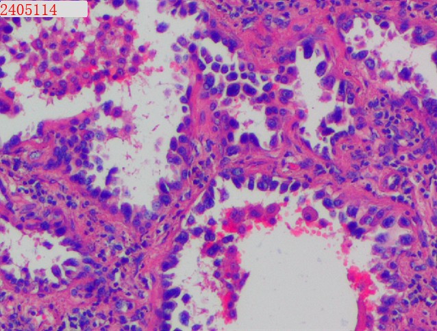肺腺癌為什么越來(lái)越多女性發(fā)生