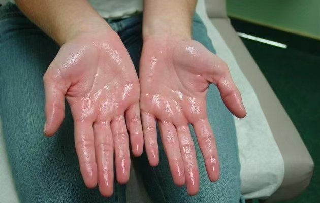 手汗癥：了解與應(yīng)對(duì)