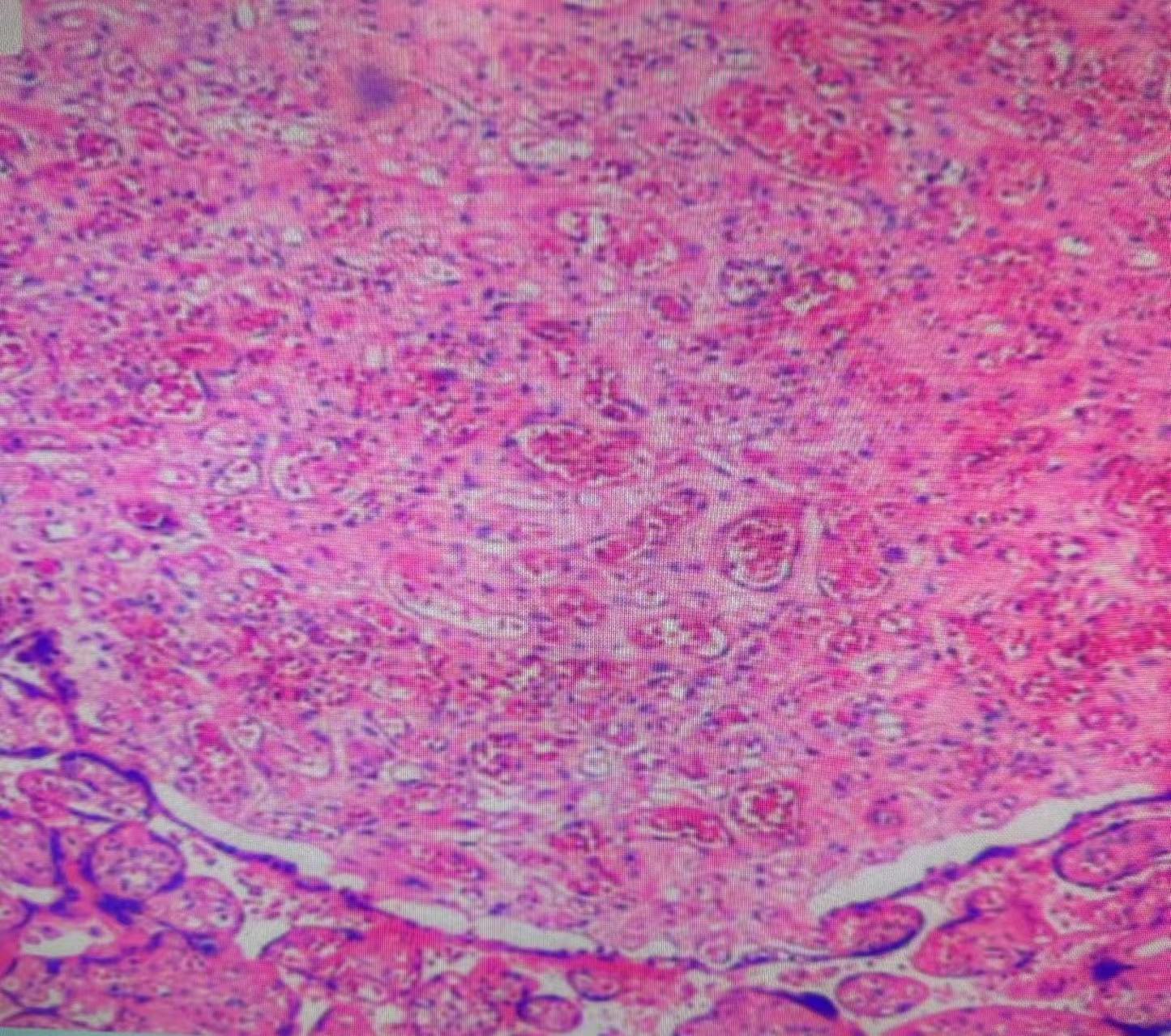 胎盤(pán)絨毛毛細(xì)血管增生病變（二）