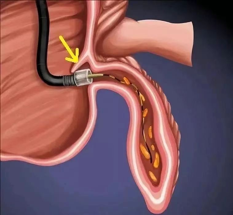 小闌尾，新世界