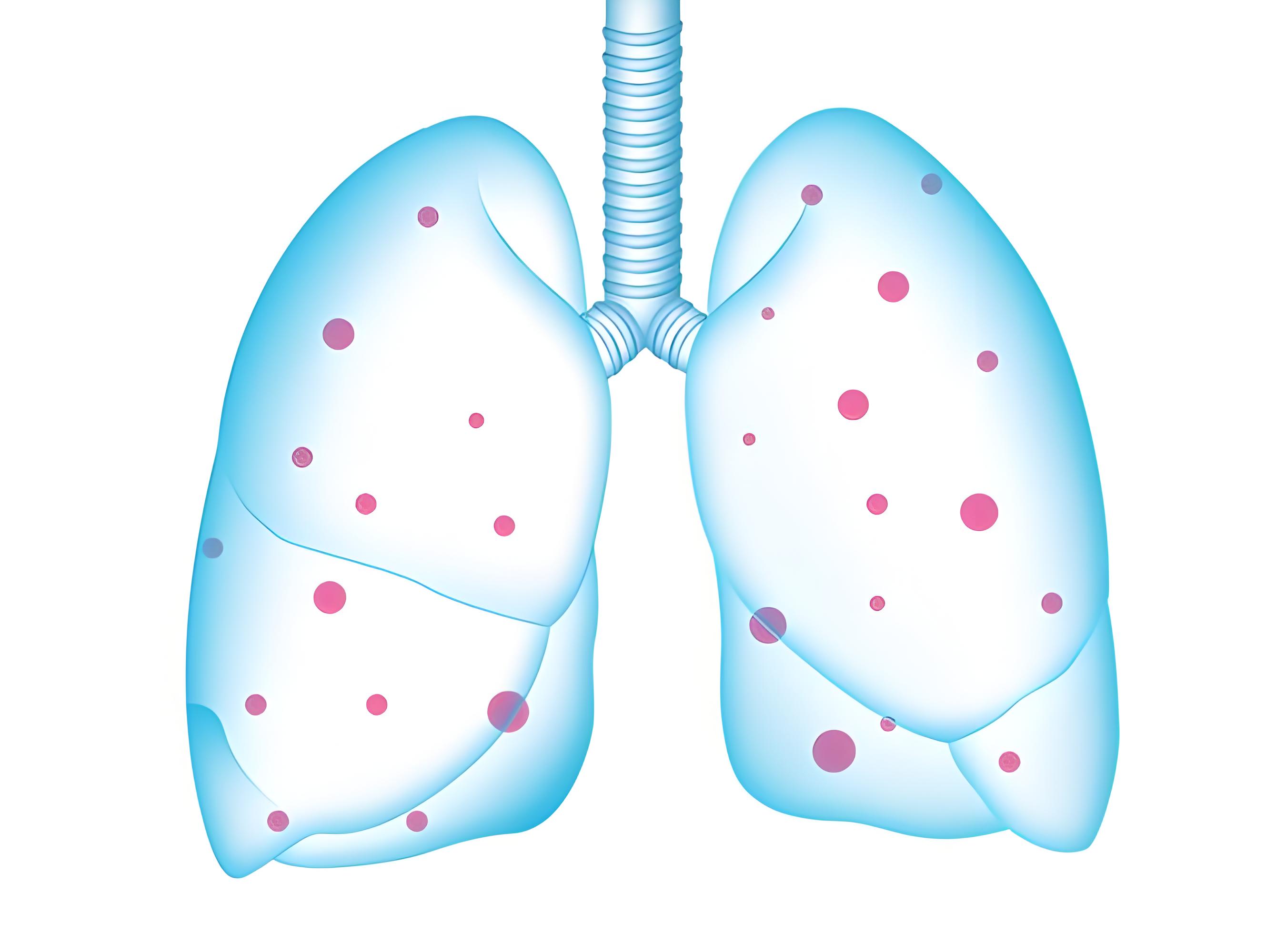 肺結(jié)節(jié)咋看良惡性？