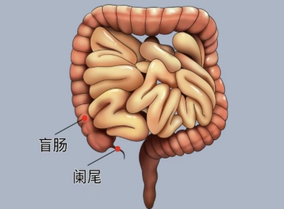 小小闌尾，不可忽視-闌尾炎