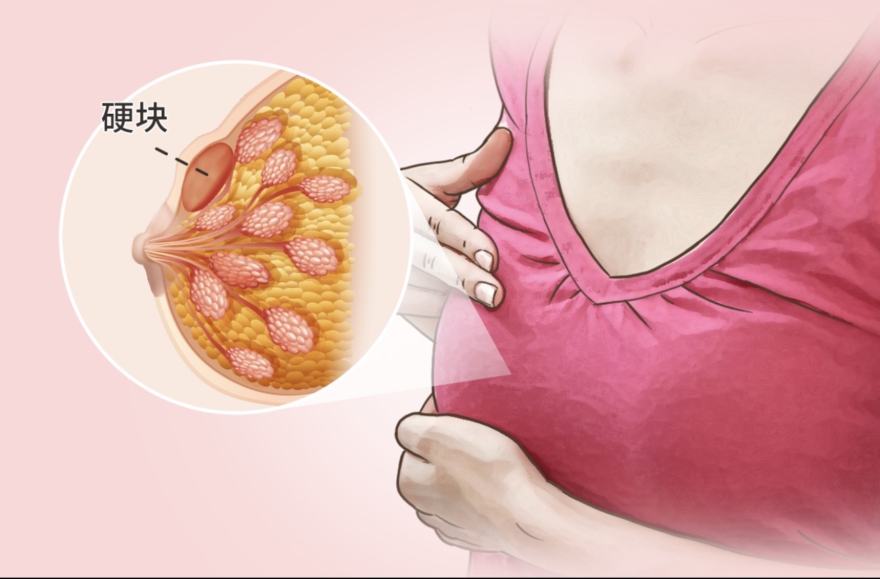 乳腺包塊別慌：揭開它的“真面目”