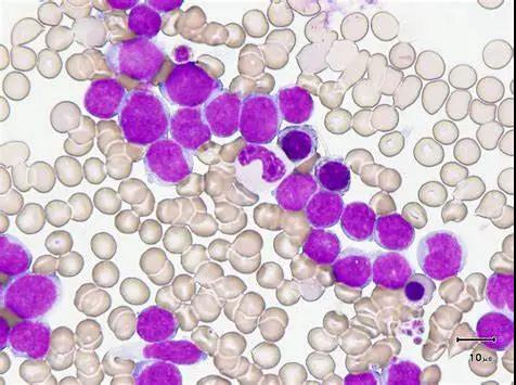 白血病融合基因檢測的意義