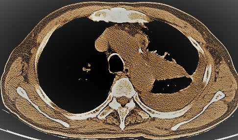 一例晚期肺癌的支氣管鏡下氬氣刀治療
